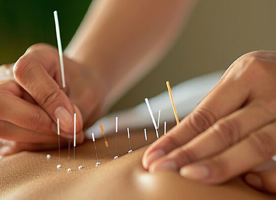 Acupuncture fidelina