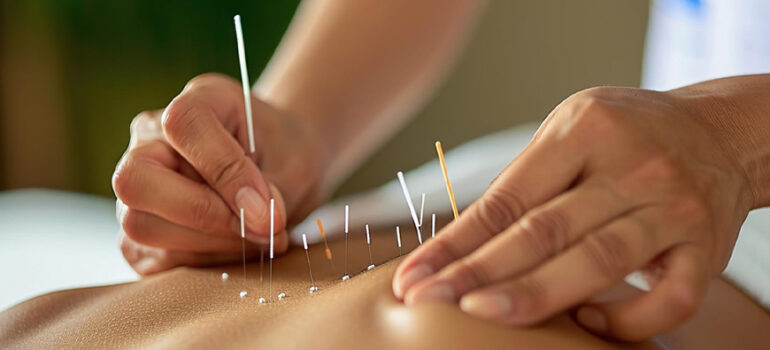 Acupuncture fidelina