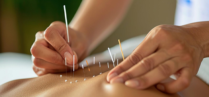 Acupuncture fidelina